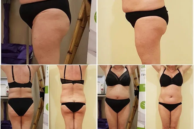 Lipo laser - vann ett bantningspris i Paris.
