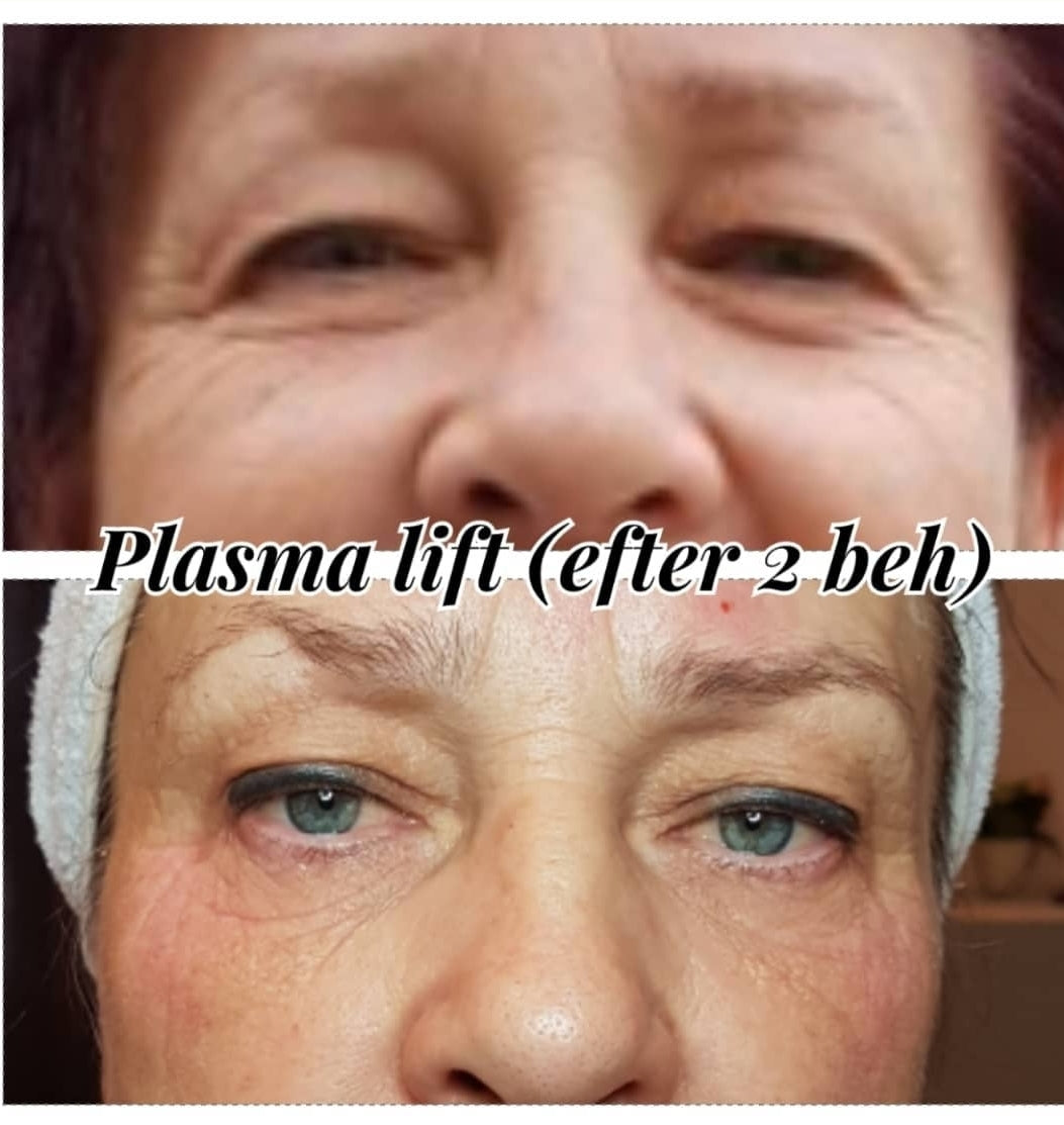 Plasma Pen behandling his Victoria Grepo Akademin.