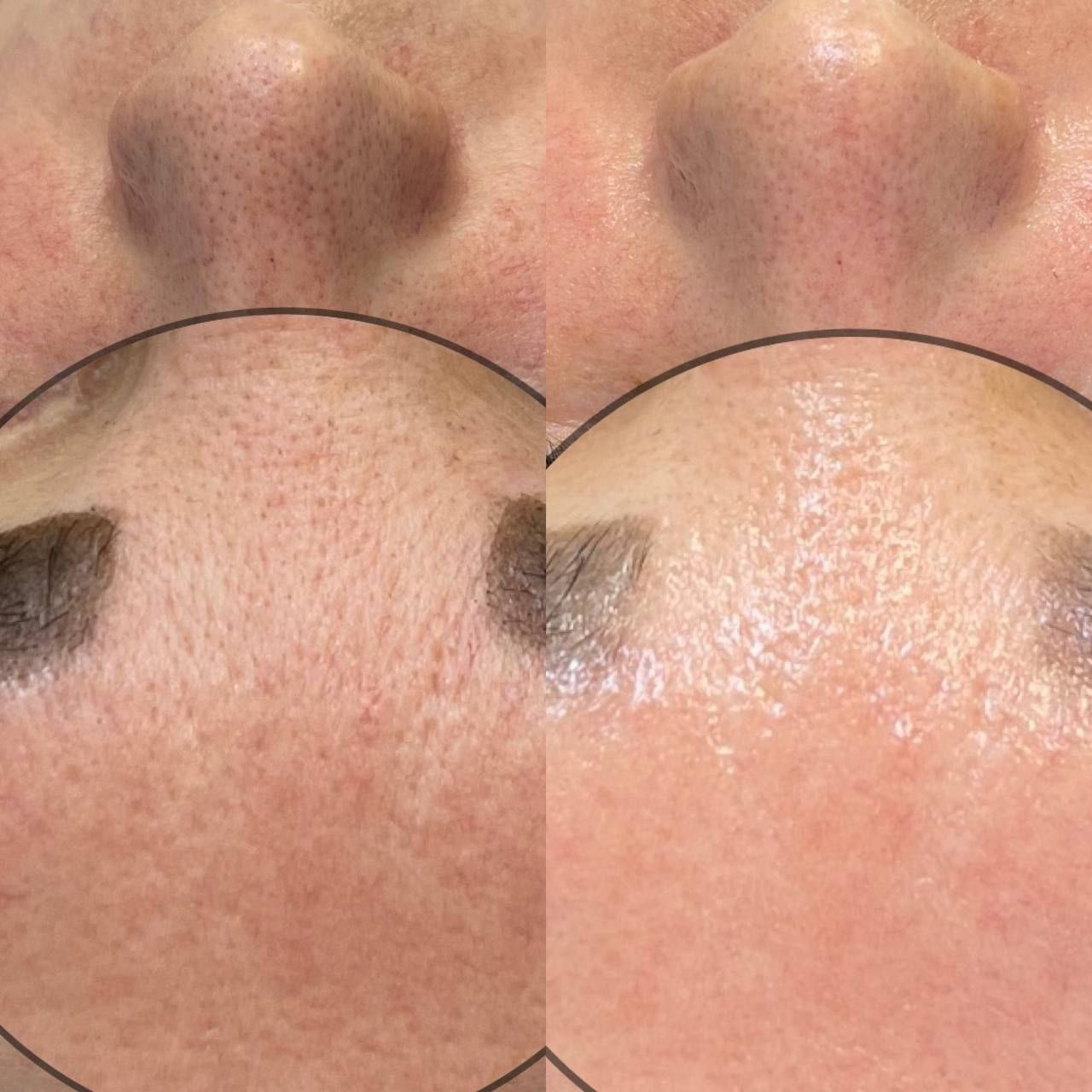 ONLINE KURS i Hydrating facial - apparatbaserad ansiktsbehandling (alla handtag)