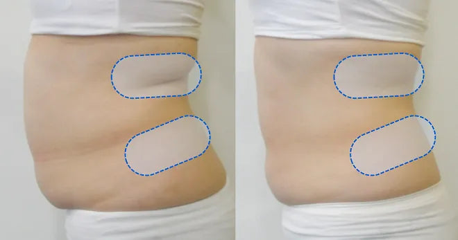Permanent fettreducering med hjälp av fettfrysning Coolshape behandling.