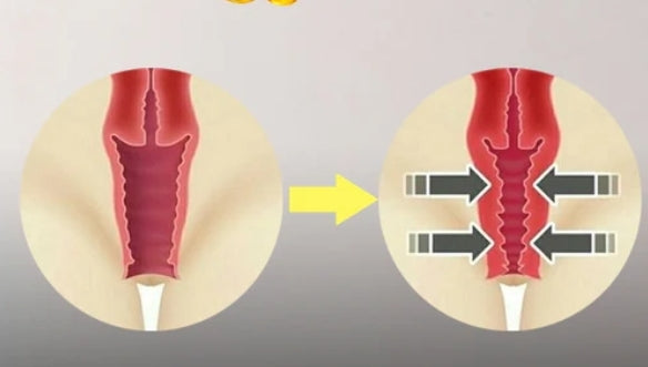Vaginal uppstramning med Hifu