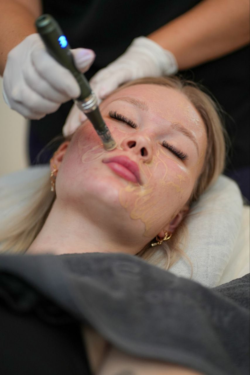 ONLINE KURS i klassisk microneedling
