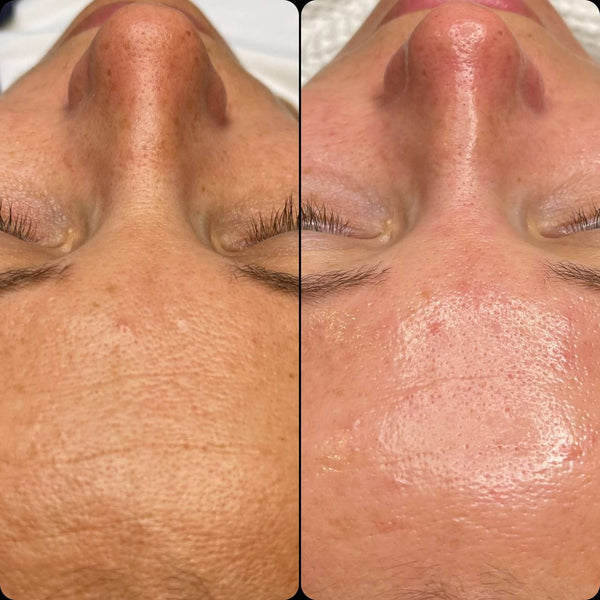 ONLINE KURS i Hydrating facial - apparatbaserad ansiktsbehandling (alla handtag)