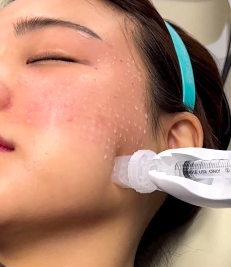 Kurs i DermaShine koreansk Microneedling /booster